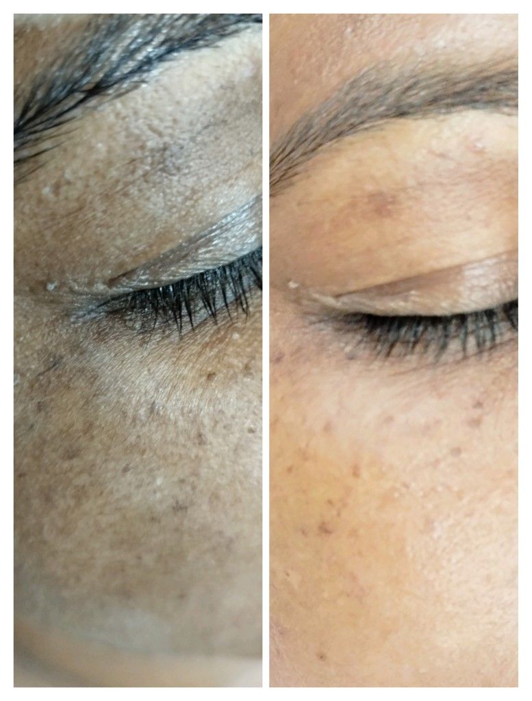 565 Melasmonil Peel before treatment